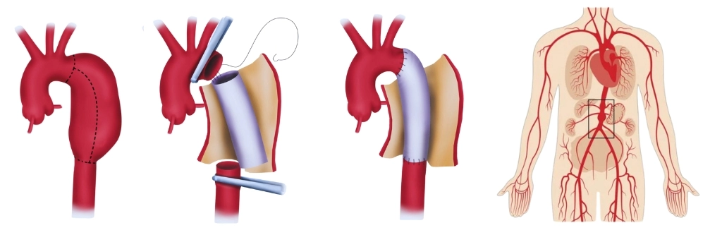 Aortic Aneurysm 