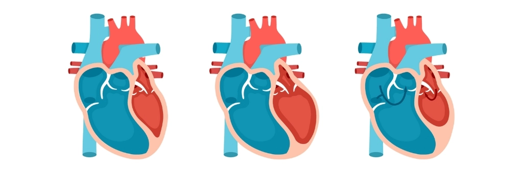 Arrhythmias