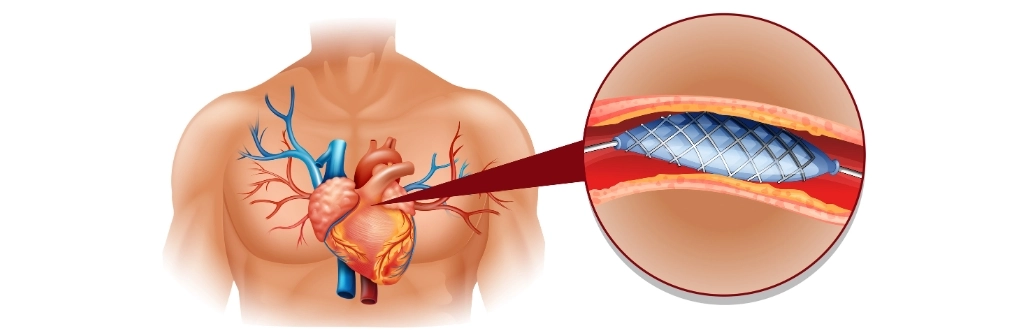 Valvular Heart Disease