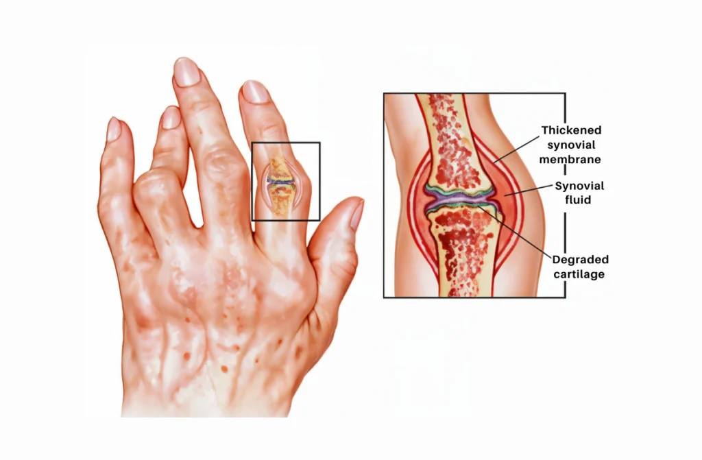 Rheumatoid Arthritis Specialist in Chennai