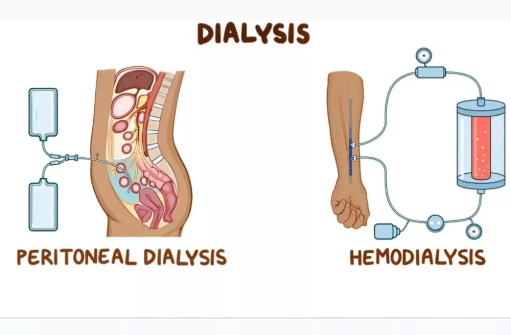 2 Types of Dialysis