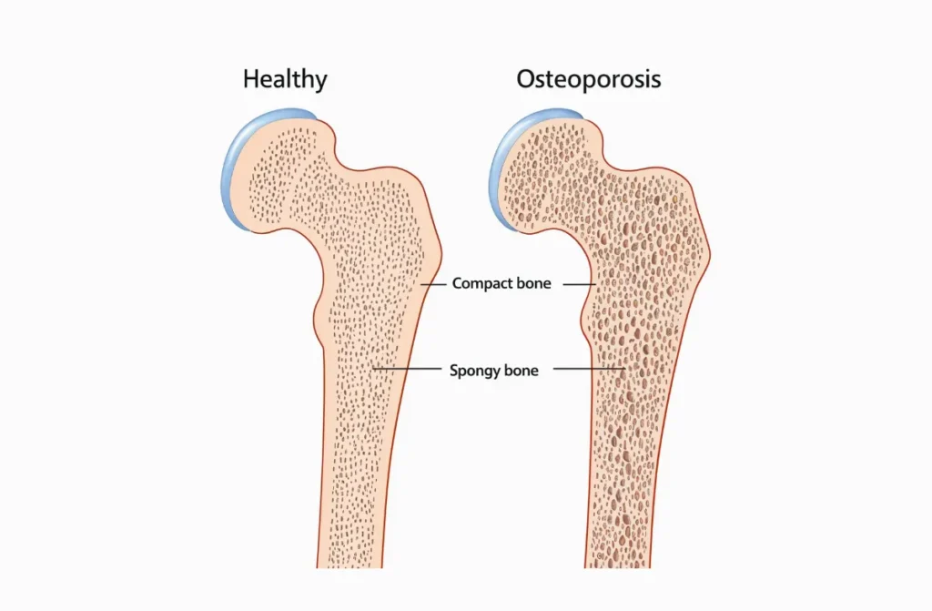 Osteoporosis in Men
