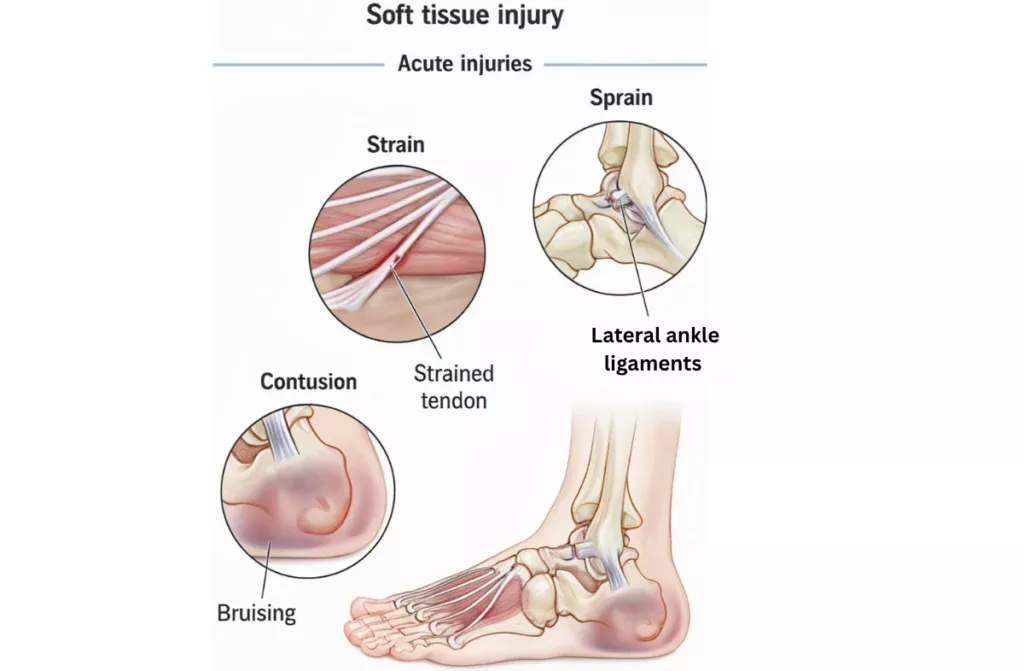 Soft Tissue Injuries