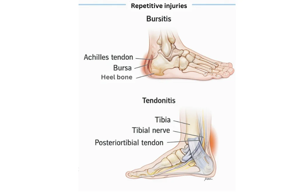 Soft Tissue Injuries