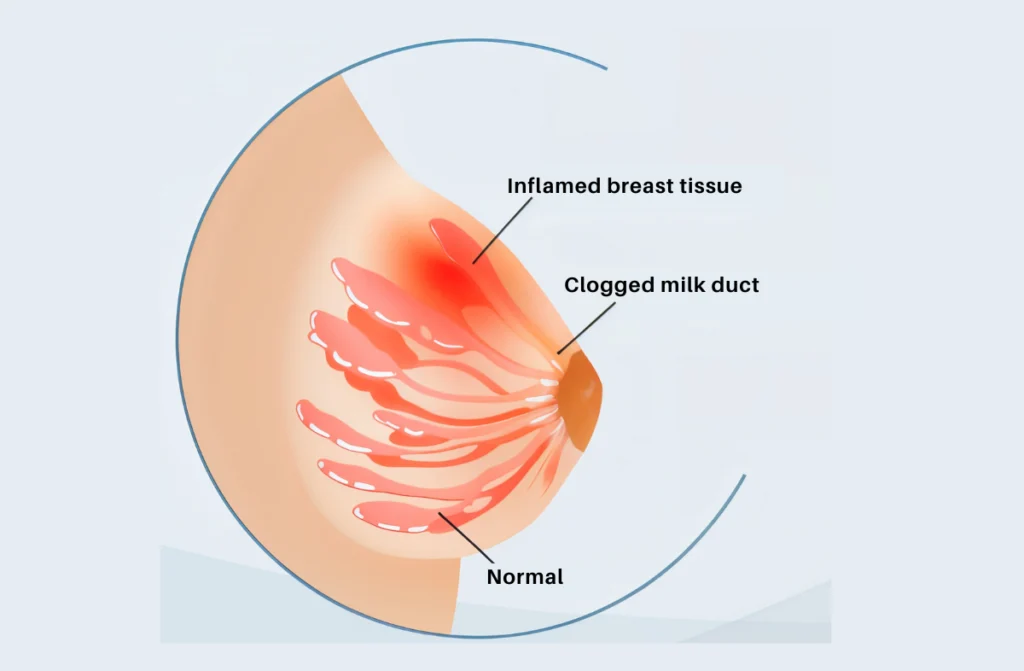 Breast Pain After Pregnancy
