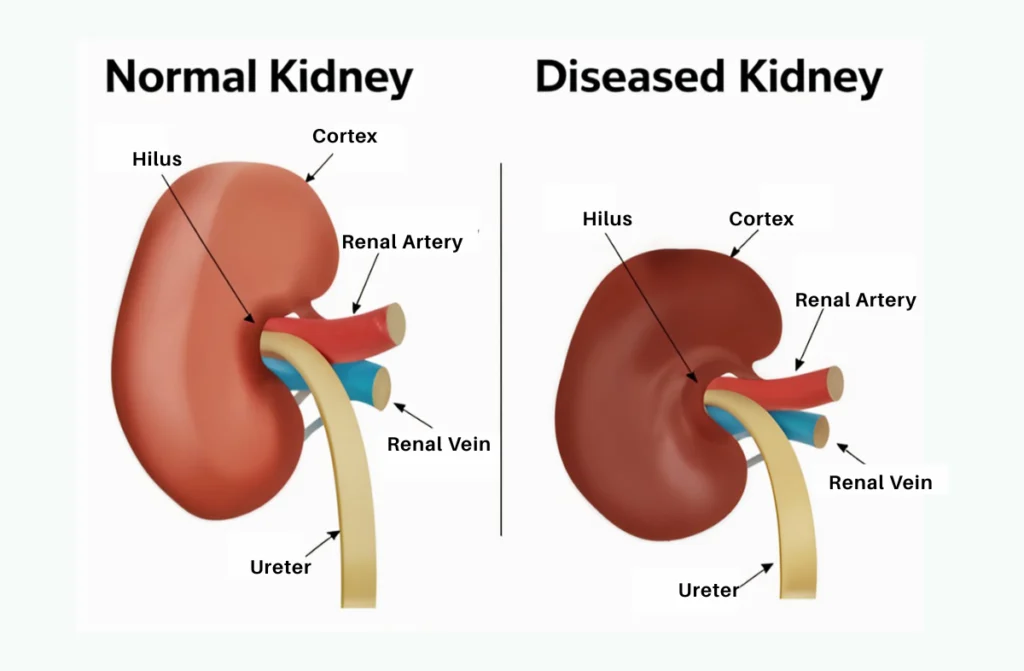 Best Nephrology Hospital in Chennai