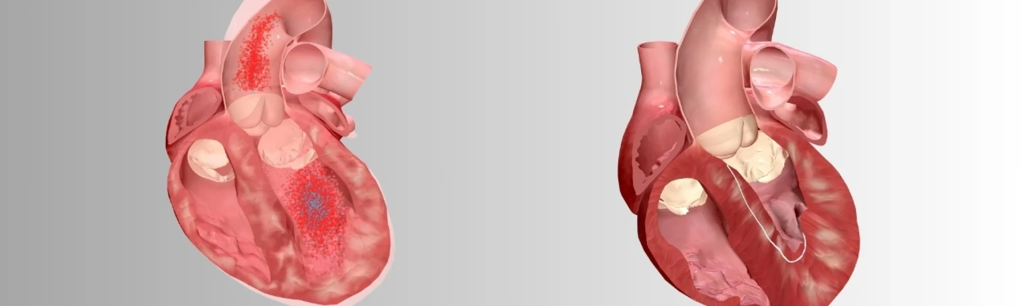 hypertrophic cardiomyopathy treatment