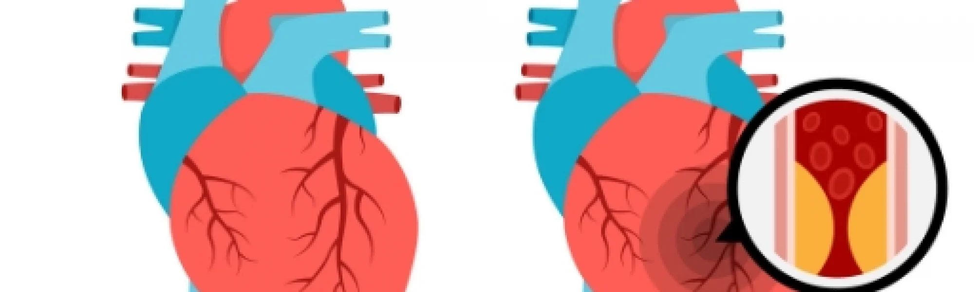 heart failure treatments