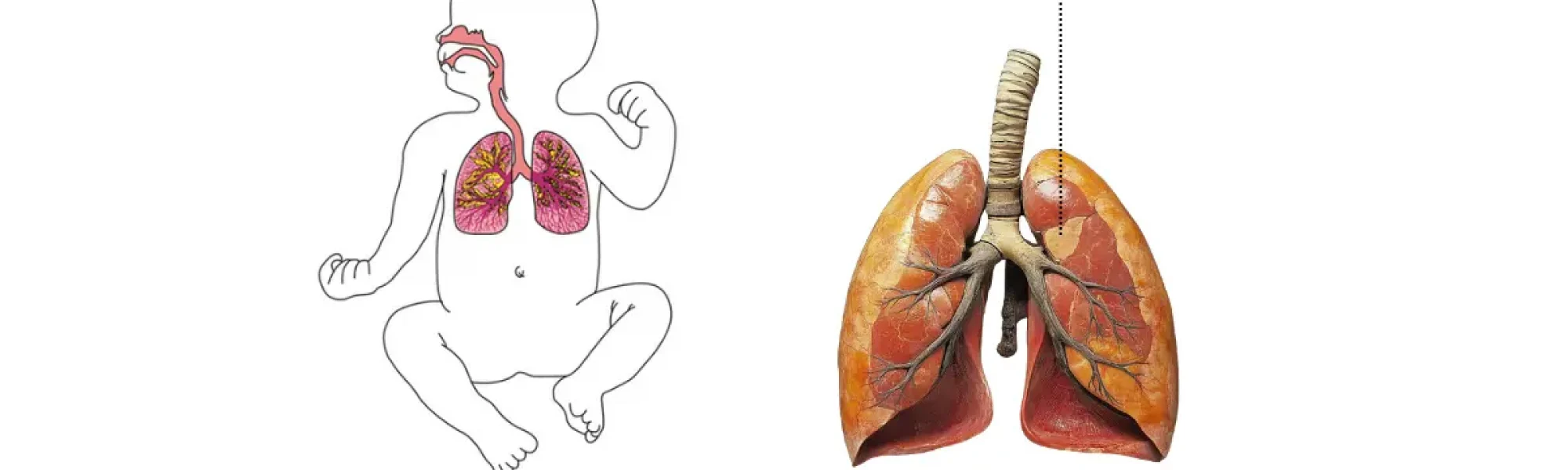 bronchopulmonary dysplasia in newborn | Medway Hospitals