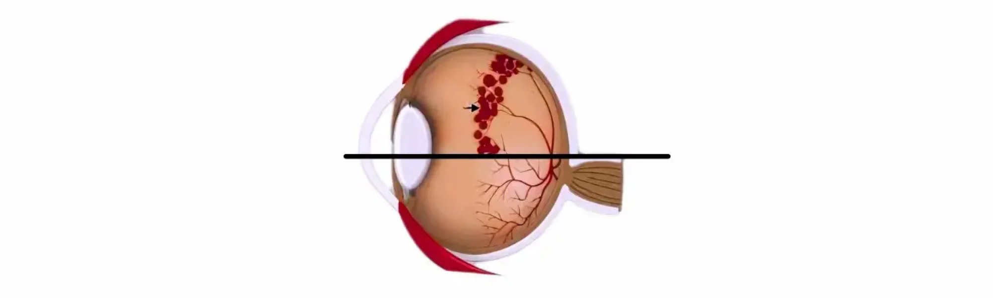 Retinopathy of prematurity treatment | Medway Hospitals